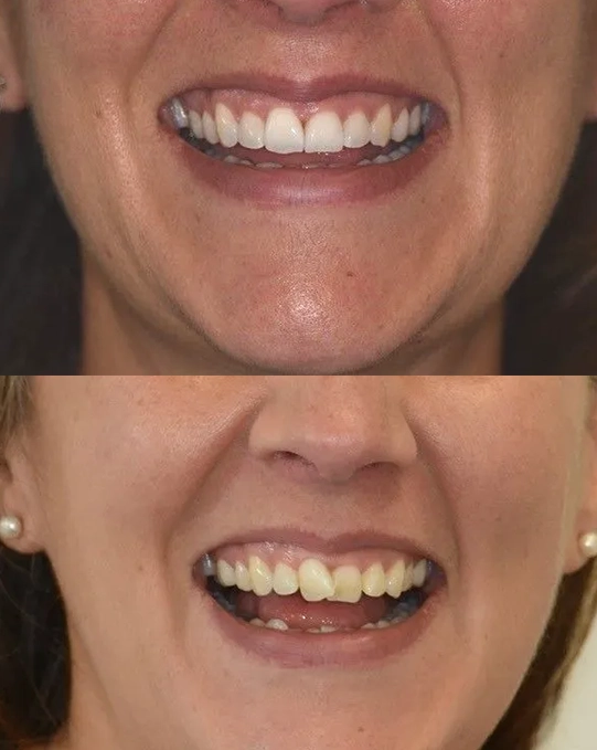 Invisalign Before & After