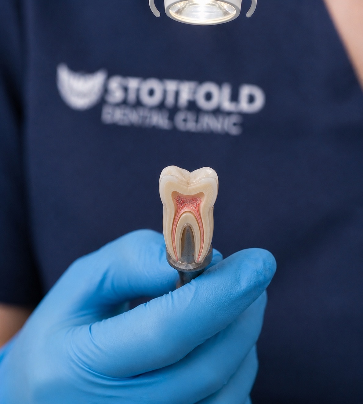 root canal