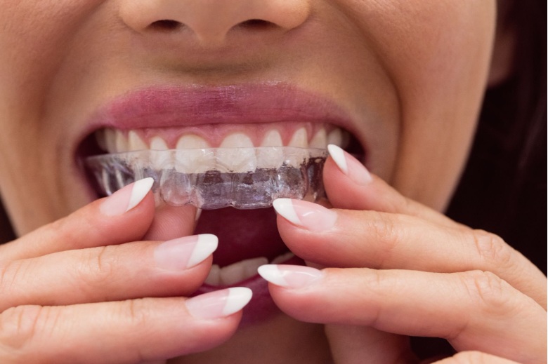Can you get invisalign with a crown