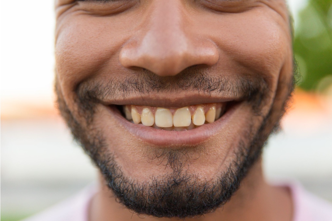 Discoloured Tooth