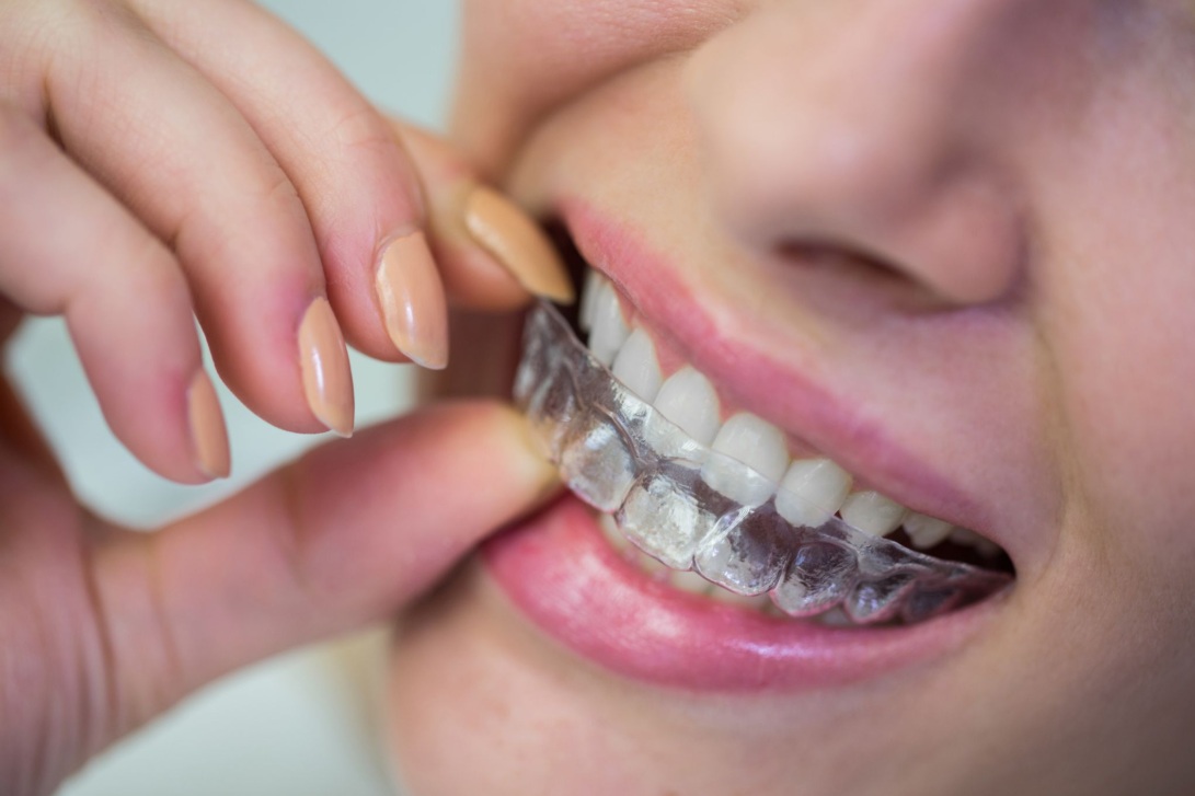 How Long Does Invisalign Take