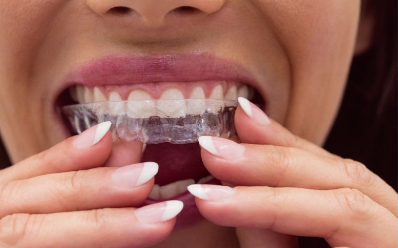 Can you get invisalign with a crown