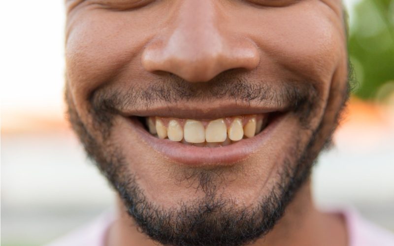 Discoloured Tooth