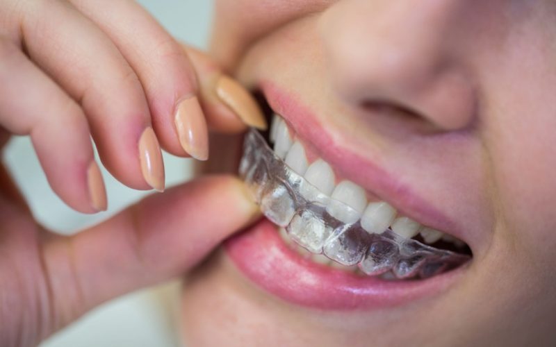 How Long Does Invisalign Take