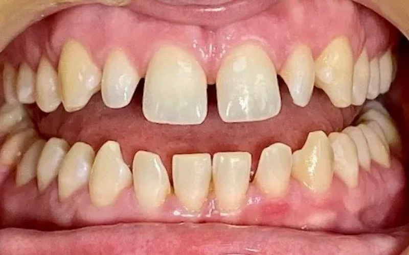 Stotfold+Invisalign+Before-1920w